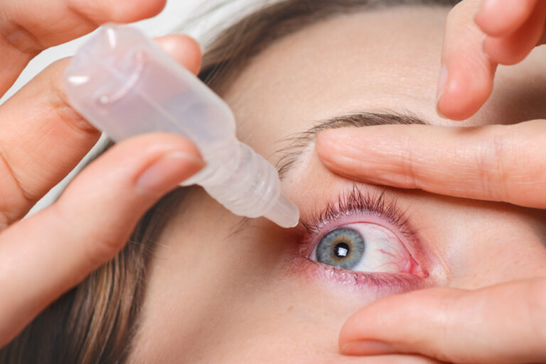 Management of Conjunctivitis